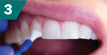  Verschmieren des Produkts auf den Zähnen